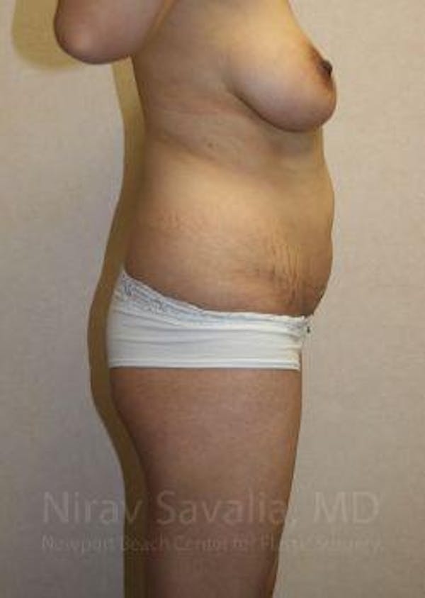 Mommy Makeover Before & After Gallery - Patient 1655648 - Image 3