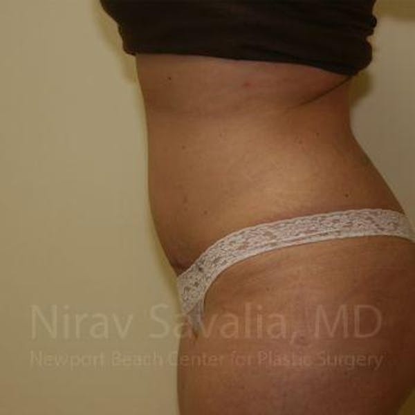 Liposuction Before & After Gallery - Patient 1655647 - Image 6