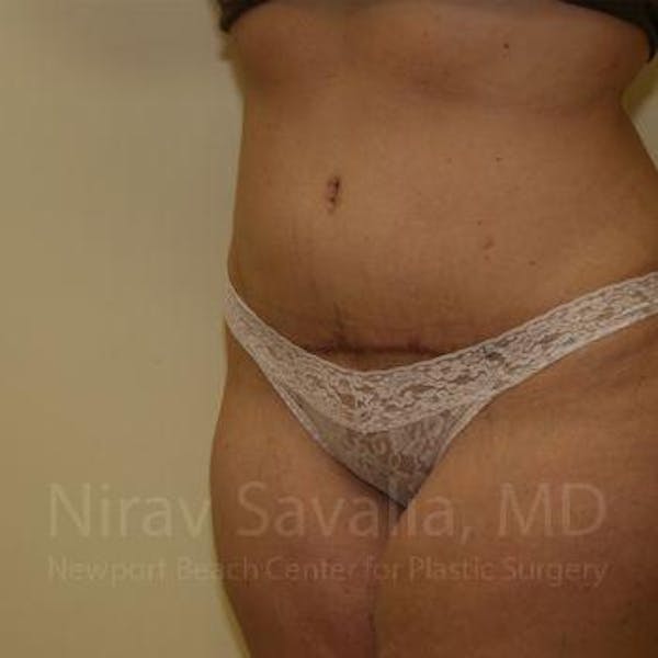 Liposuction Gallery - Patient 1655647 - Image 8