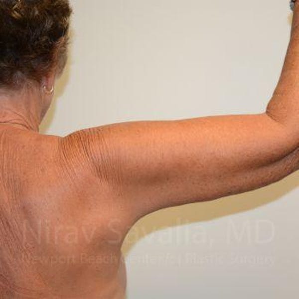 Body Contouring after Weight Loss Before & After Gallery - Patient 1655646 - Image 8