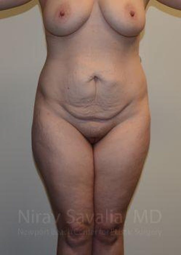 Liposuction Gallery - Patient 1655652 - Image 1