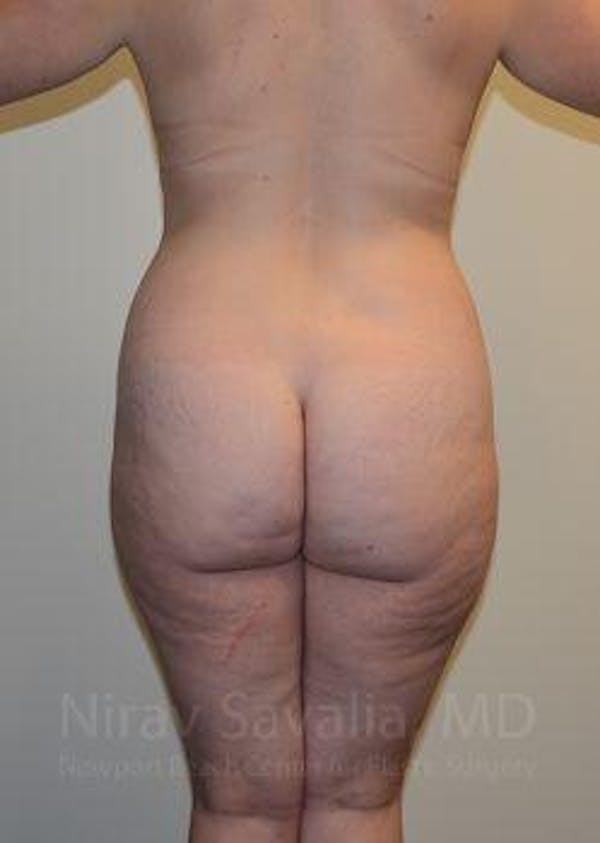Liposuction Before & After Gallery - Patient 1655652 - Image 3