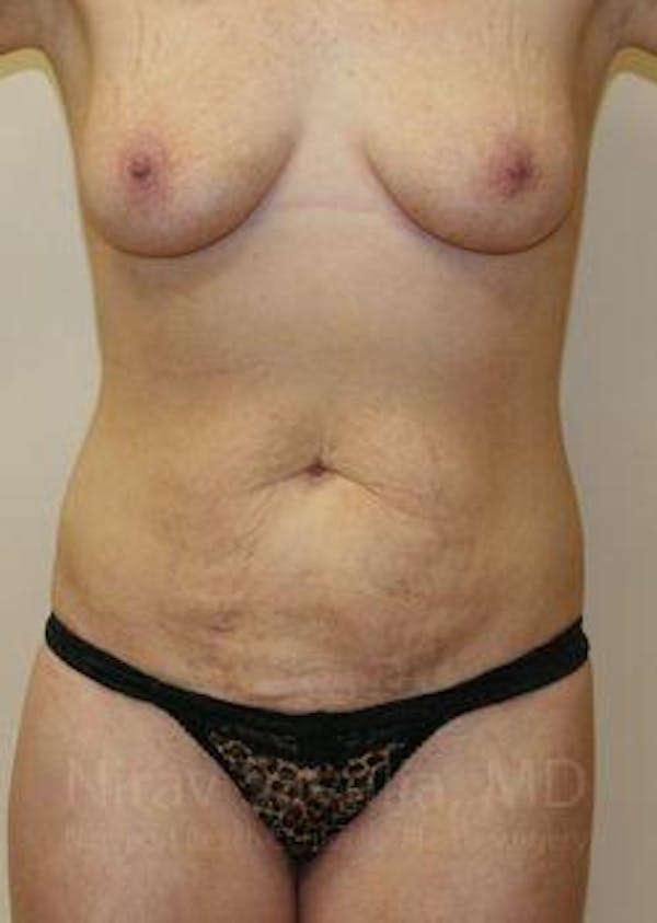 Mommy Makeover Before & After Gallery - Patient 1655651 - Image 1