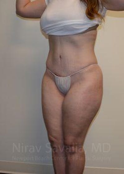 Liposuction Before & After Gallery - Patient 1655652 - Image 8