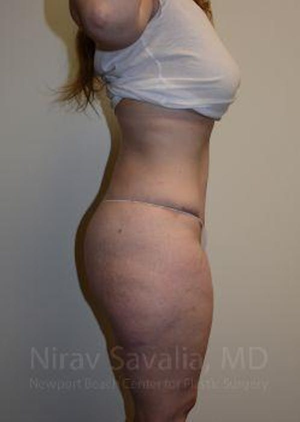 Liposuction Before & After Gallery - Patient 1655652 - Image 10