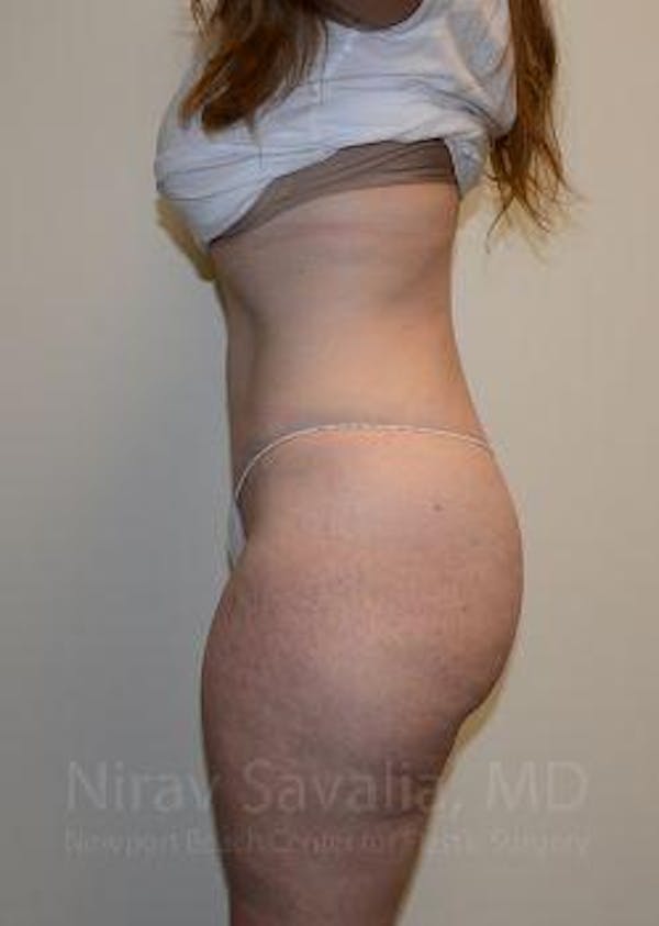 Liposuction Before & After Gallery - Patient 1655652 - Image 12