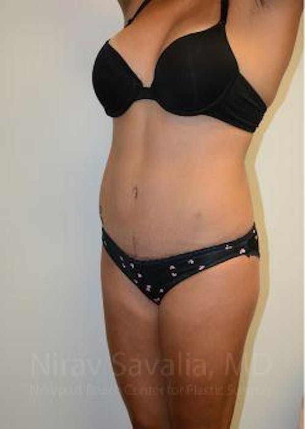 Abdominoplasty / Tummy Tuck Before & After Gallery - Patient 1655653 - Image 4