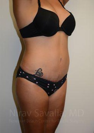 Abdominoplasty / Tummy Tuck Before & After Gallery - Patient 1655653 - Image 6