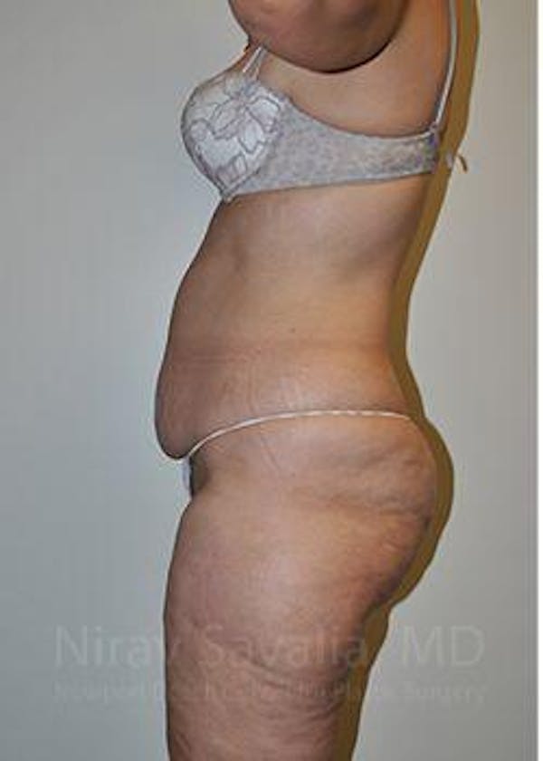 Liposuction Before & After Gallery - Patient 1655654 - Image 3