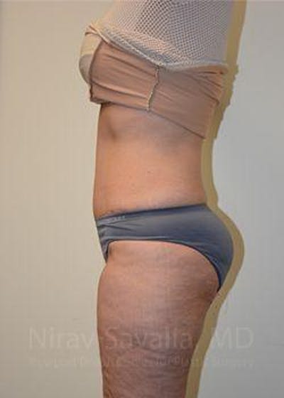 Liposuction Before & After Gallery - Patient 1655654 - Image 4