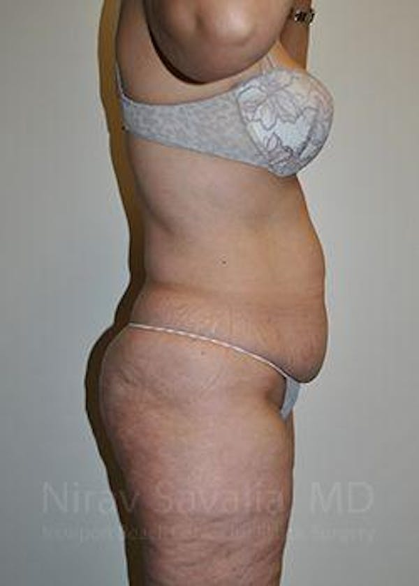 Liposuction Before & After Gallery - Patient 1655654 - Image 5