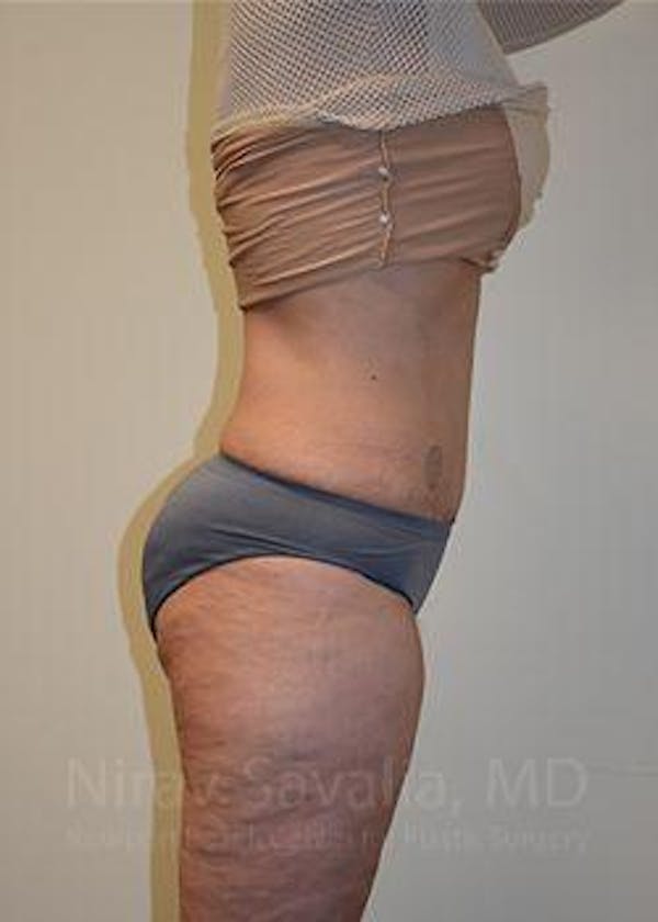 Liposuction Before & After Gallery - Patient 1655654 - Image 6