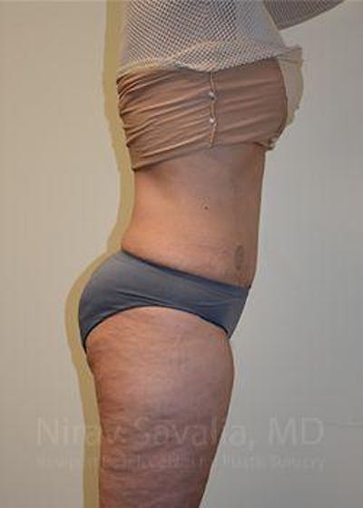 Liposuction Before & After Gallery - Patient 1655654 - Image 6