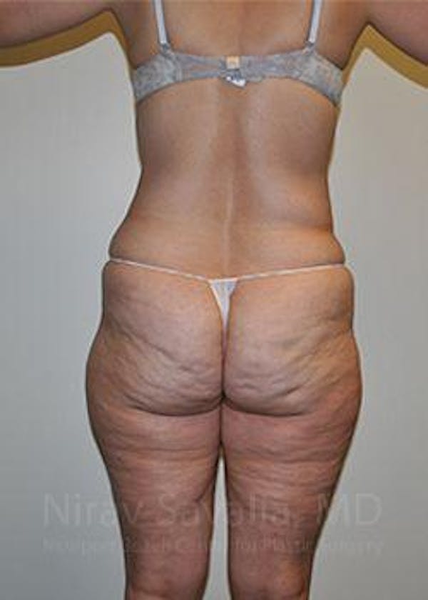 Liposuction Before & After Gallery - Patient 1655654 - Image 7