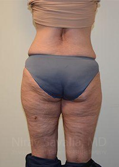 Liposuction Before & After Gallery - Patient 1655654 - Image 8