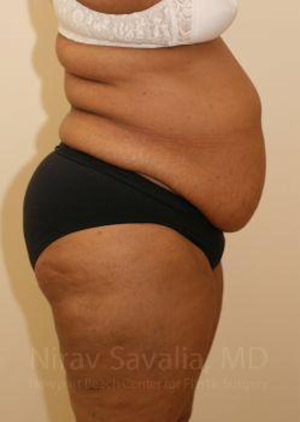 Abdominoplasty / Tummy Tuck Before & After Gallery - Patient 1655655 - Image 3