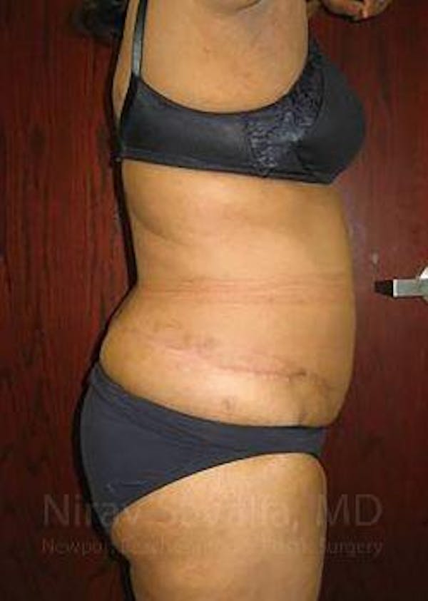 Abdominoplasty / Tummy Tuck Before & After Gallery - Patient 1655655 - Image 4