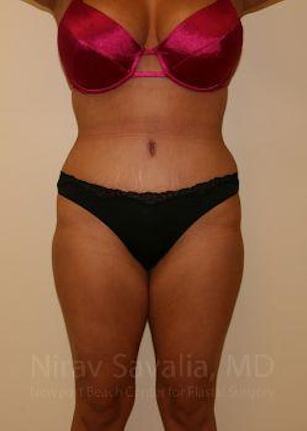 Liposuction Before & After Gallery - Patient 1655656 - Image 2