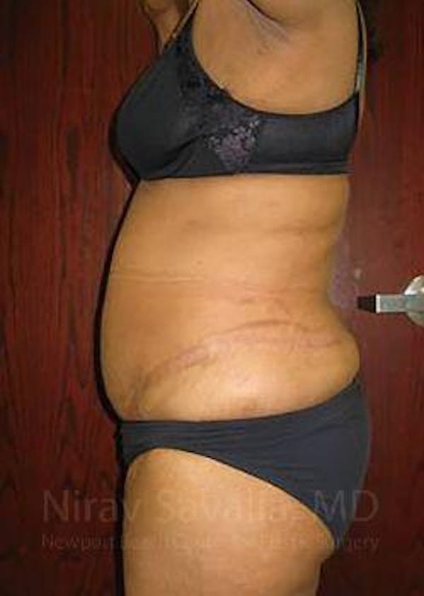 Abdominoplasty / Tummy Tuck Before & After Gallery - Patient 1655655 - Image 6