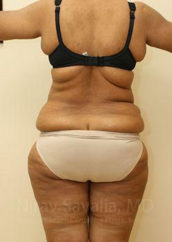 Abdominoplasty / Tummy Tuck Before & After Gallery - Patient 1655655 - Image 7