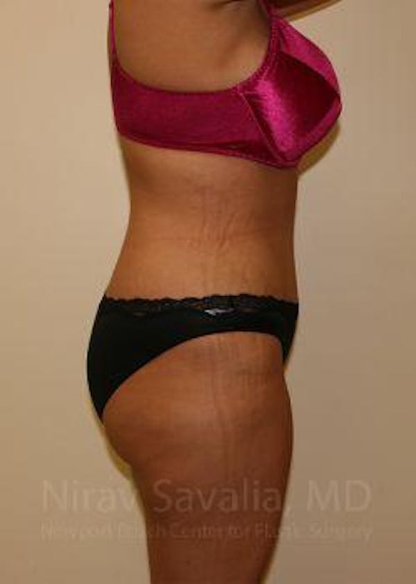 Liposuction Before & After Gallery - Patient 1655656 - Image 6