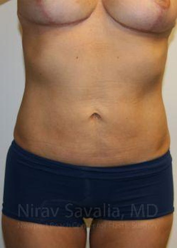 Liposuction Before & After Gallery - Patient 1655658 - Image 2