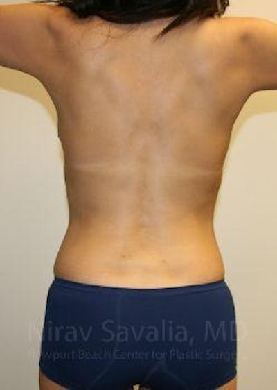 Liposuction Before & After Gallery - Patient 1655658 - Image 4