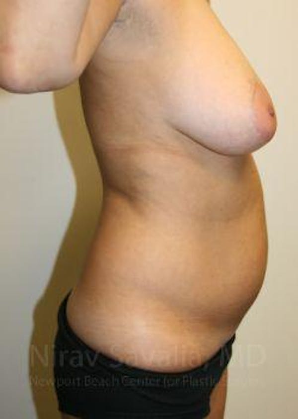Liposuction Before & After Gallery - Patient 1655658 - Image 9