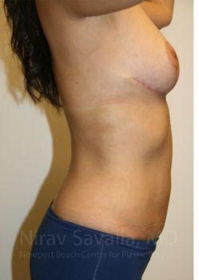 Liposuction Before & After Gallery - Patient 1655658 - Image 10