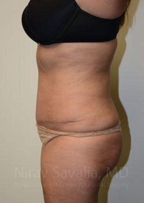 Abdominoplasty / Tummy Tuck Gallery - Patient 1655659 - Image 6