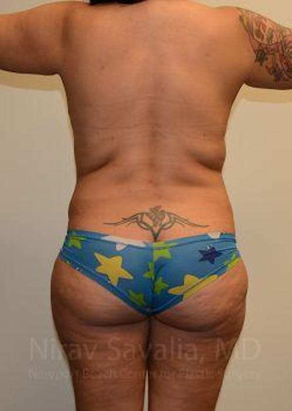 Liposuction Before & After Gallery - Patient 1655660 - Image 3