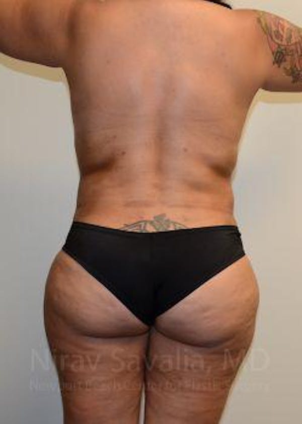 Liposuction Before & After Gallery - Patient 1655660 - Image 4