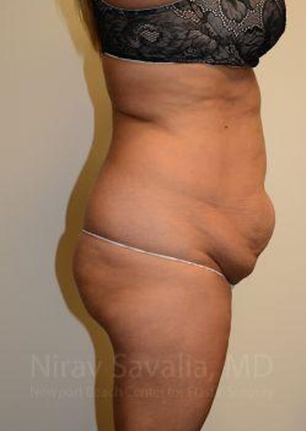 Abdominoplasty / Tummy Tuck Before & After Gallery - Patient 1655659 - Image 7