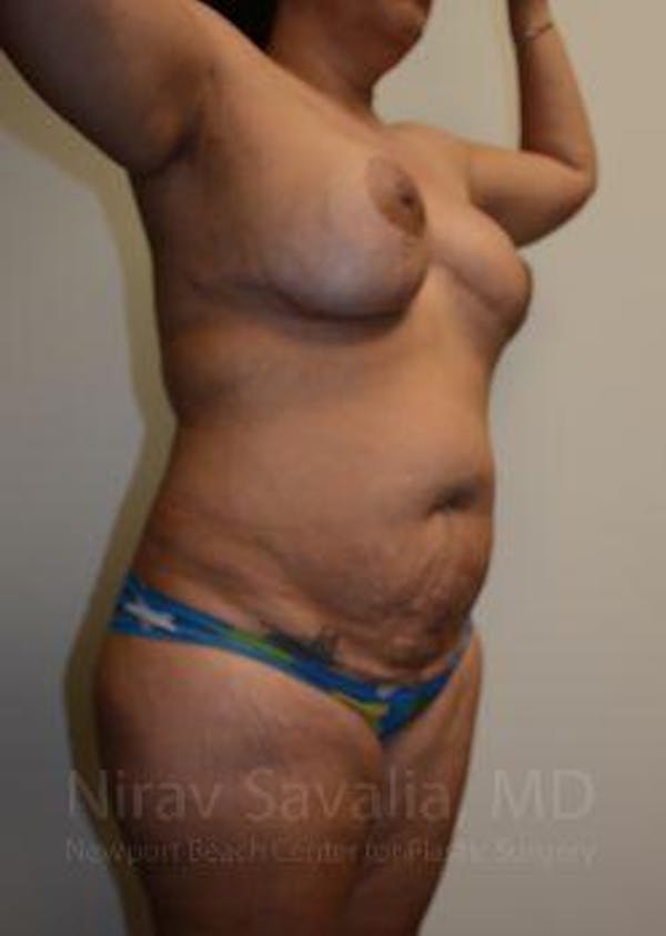 Liposuction Before & After Gallery - Patient 1655660 - Image 7