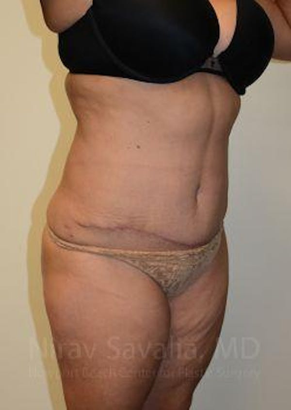Abdominoplasty / Tummy Tuck Before & After Gallery - Patient 1655659 - Image 10