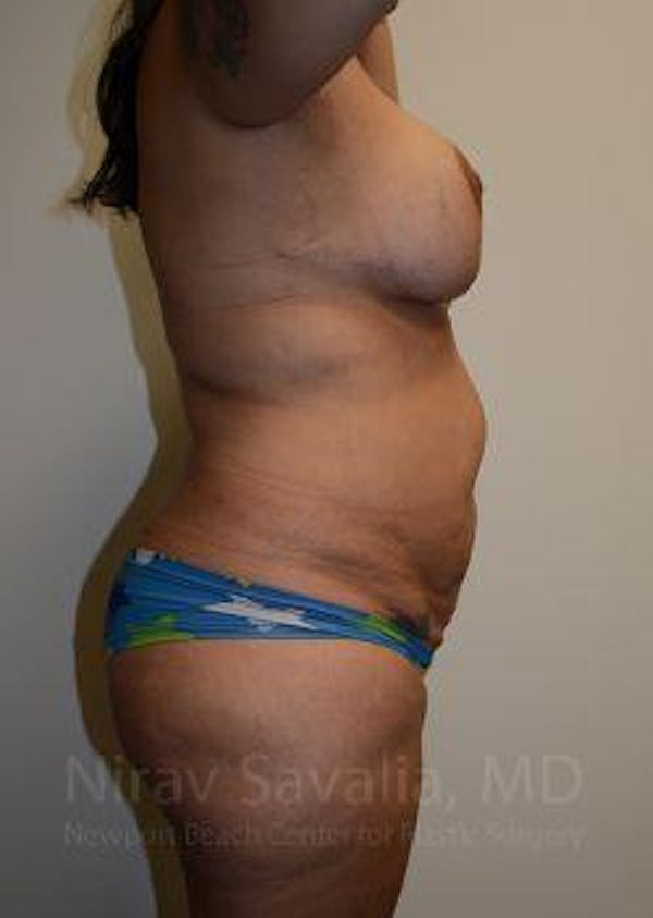 Liposuction Before & After Gallery - Patient 1655660 - Image 9