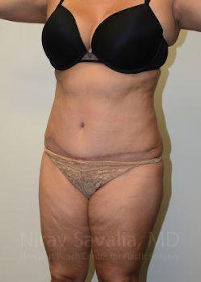 Abdominoplasty / Tummy Tuck Gallery - Patient 1655659 - Image 12