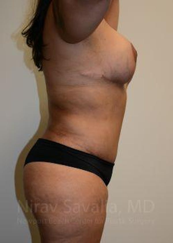 Liposuction Before & After Gallery - Patient 1655660 - Image 10
