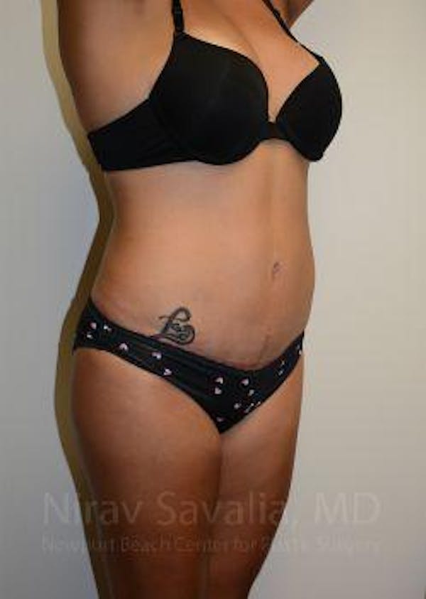 Liposuction Before & After Gallery - Patient 1655662 - Image 6