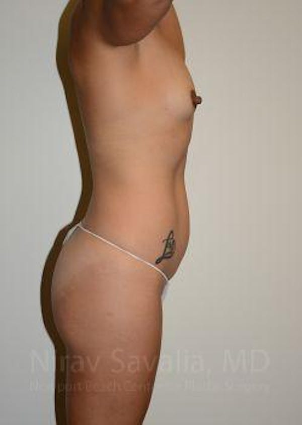 Liposuction Before & After Gallery - Patient 1655662 - Image 9