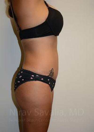 Liposuction Before & After Gallery - Patient 1655662 - Image 10