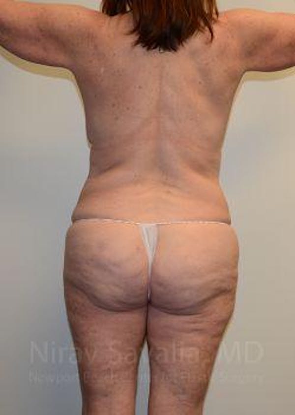 Abdominoplasty / Tummy Tuck Before & After Gallery - Patient 1655663 - Image 3