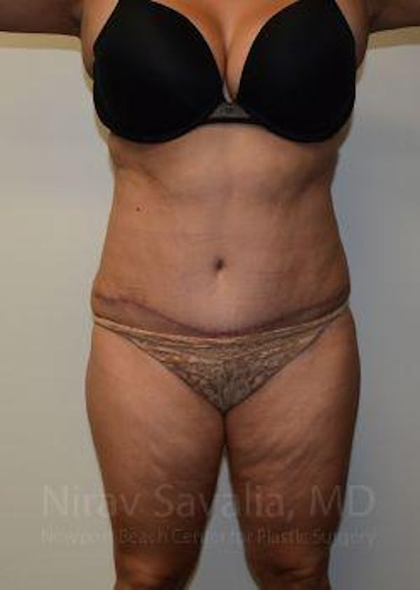 Liposuction Before & After Gallery - Patient 1655664 - Image 2