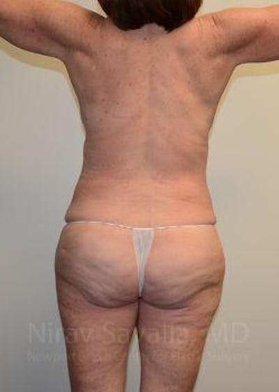 Abdominoplasty / Tummy Tuck Before & After Gallery - Patient 1655663 - Image 4