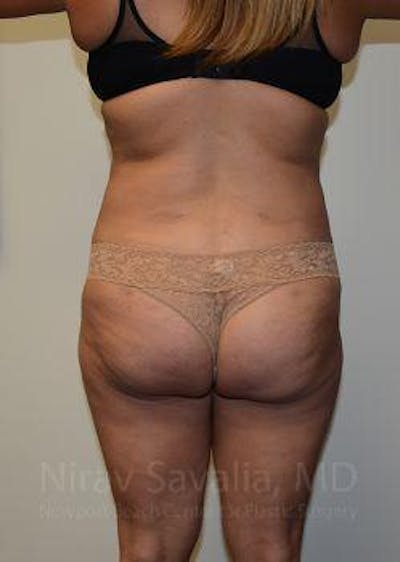 Liposuction Before & After Gallery - Patient 1655664 - Image 4