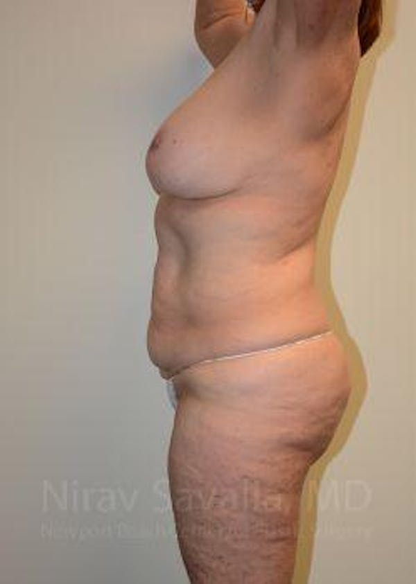 Abdominoplasty / Tummy Tuck Before & After Gallery - Patient 1655663 - Image 5