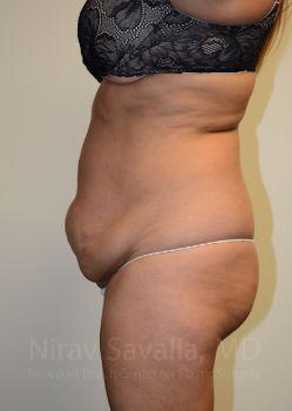 Liposuction Before & After Gallery - Patient 1655664 - Image 5