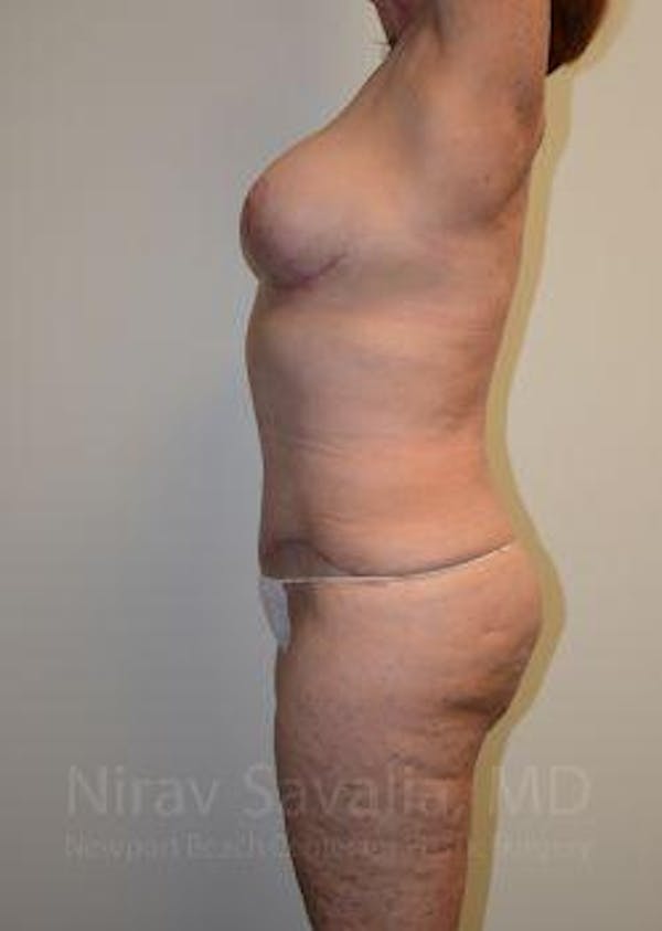 Abdominoplasty / Tummy Tuck Before & After Gallery - Patient 1655663 - Image 6
