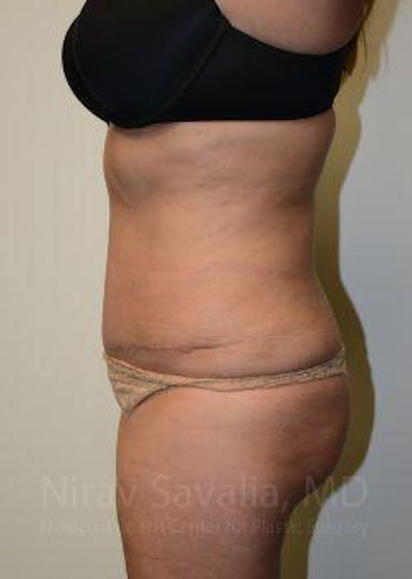 Liposuction Before & After Gallery - Patient 1655664 - Image 6