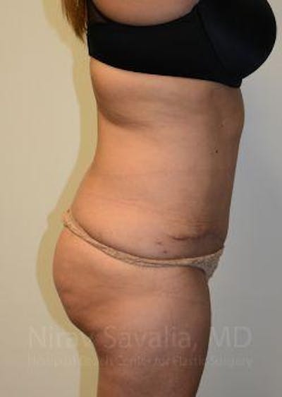 Liposuction Gallery - Patient 1655664 - Image 8